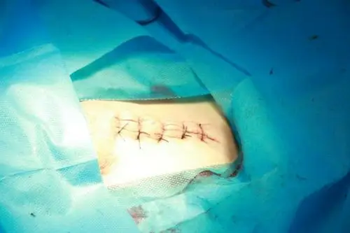 宫外孕手术,子宫肌瘤手术,子宫切除手术等,来病房7楼0372---8706127