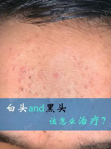 这是长在10来岁男孩额头的典型的黑头粉刺和白头粉刺,很多是黑头粉刺.