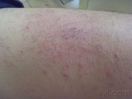 爱爱医病例中心 皮肤性病科 皮肤科 看图识病:夏季皮炎