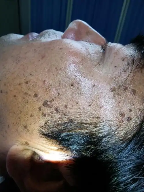 扁平疣老年斑,一次效果