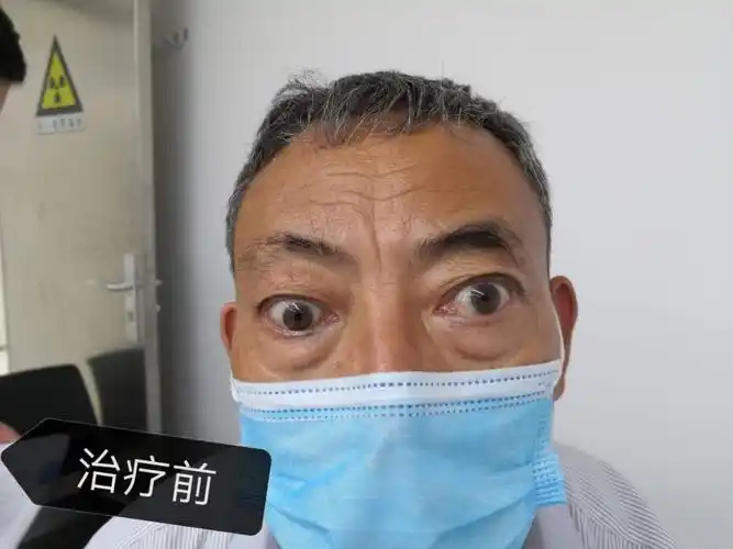 甲亢突眼重在早期预防和治疗(广州)