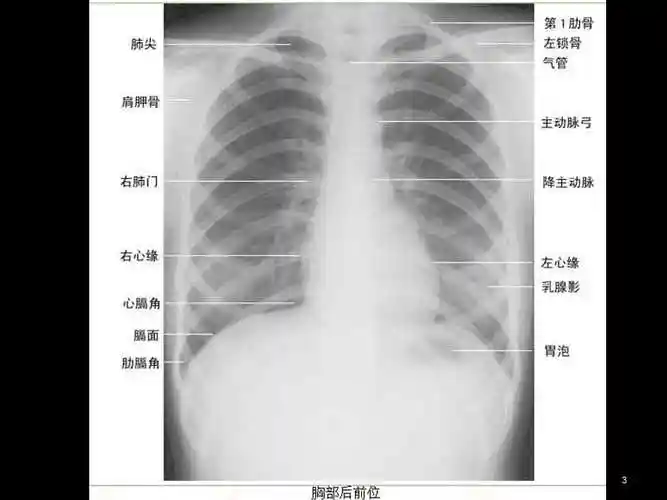 肺部大体解剖和x线下分叶分段幻灯片ppt