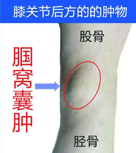 膝关节镜微创切除腘窝囊肿