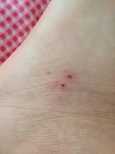 脚好像被老鼠咬了,应该三四天了,昨天才发现的,之前没觉得疼,现在很