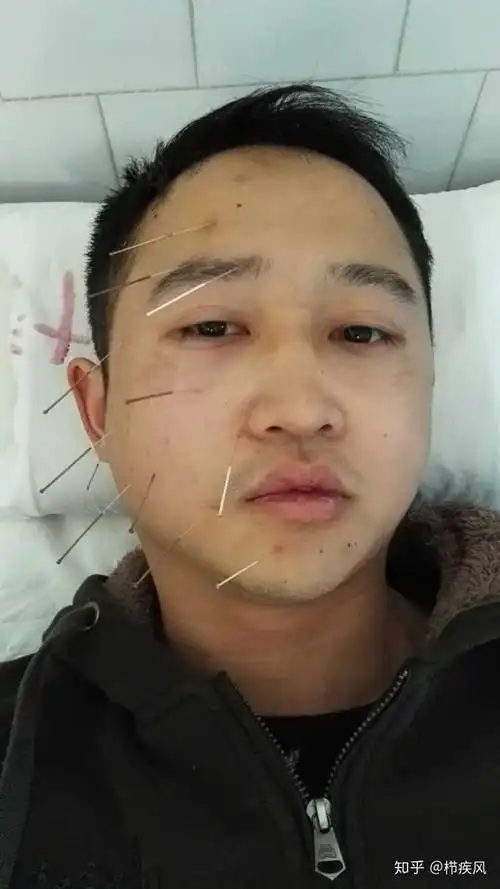 面瘫是一种什么样的体验?