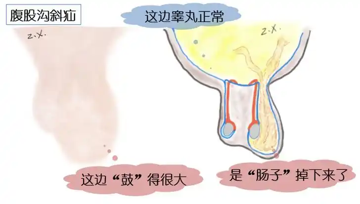 "疝气",即"腹股沟斜疝",也会让蛋蛋的形状发生变化.