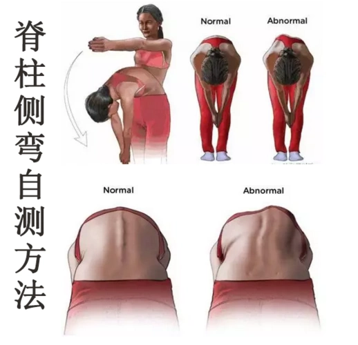 康睿仕案例分享:脊柱侧弯矫正,历时1个月体态有了较大明显改善__凤凰