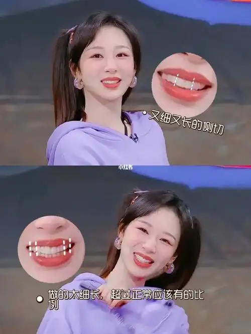 大家都知道杨紫做过矫正,对吧,然后应该是现在也还没做完,节目里会
