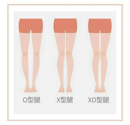 你是o型腿么