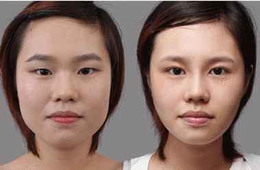 割的双眼皮还能做单眼皮吗