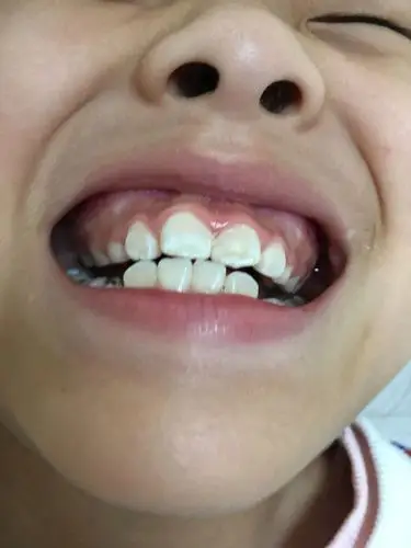 女儿10虚岁,牙齿感觉有些往外突出,不知道该不该带牙套,希望专业医师