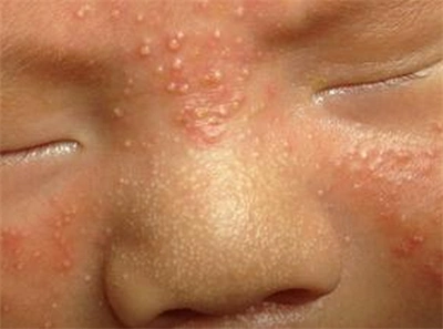 新生儿痤疮的症状有哪些