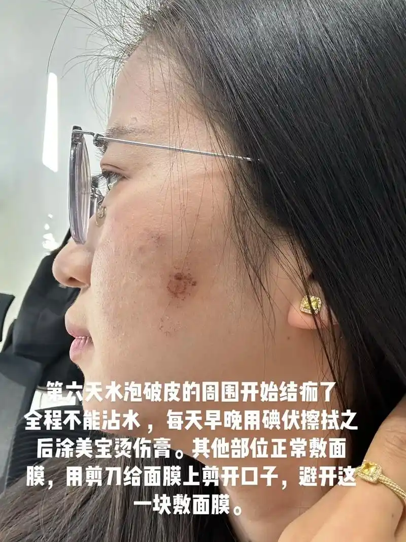 光子嫩肤 #超光子烫伤  第六天水泡破皮的周围开始结痂了 全程不能沾