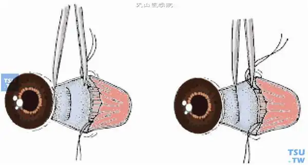 斜视直肌后徙术操作及注意事项
