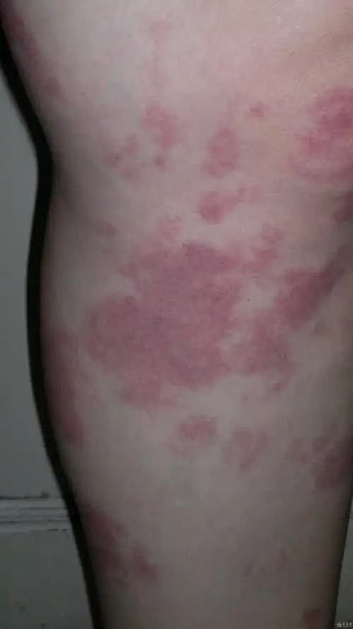 好大面积的鲜红斑痣,如何根治?