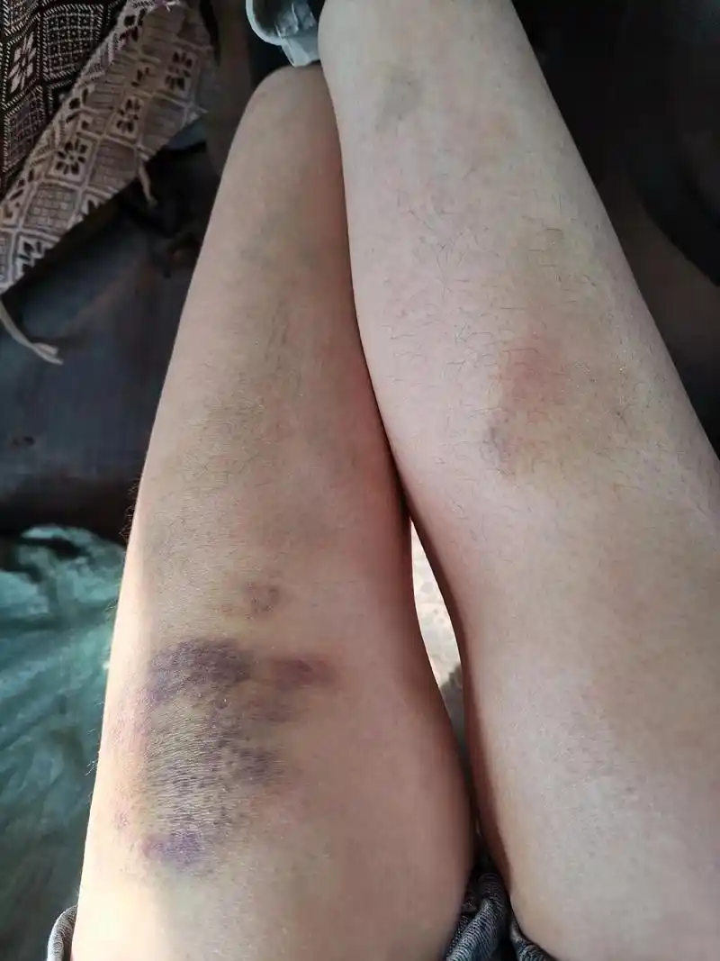 遍体鳞伤 #痛苦的滋味 #狼狈不堪的样子 #除了坚强别无选 - 抖音