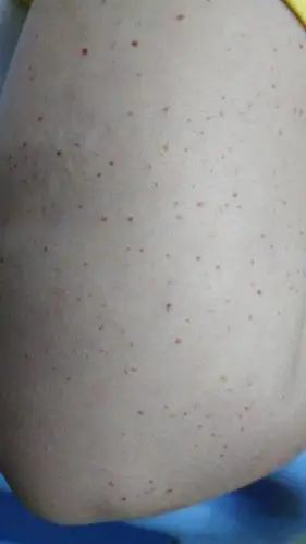 手臂上的小血斑越来越多了?