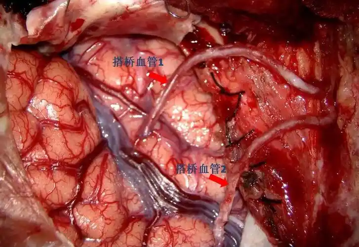 脑血管搭桥手术开颅吗?风险大不大? - 好大夫在线