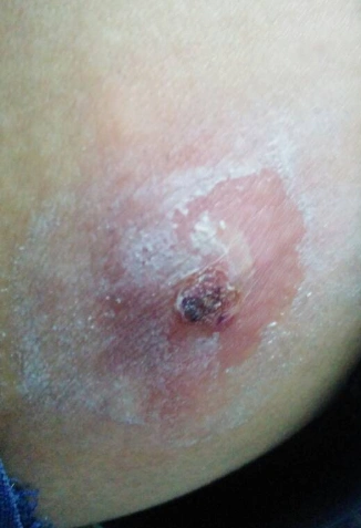 臀部火疖子图片4