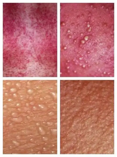 热化了!痱子,湿疹,淹脖子,蚊子包全来了,怎么办?