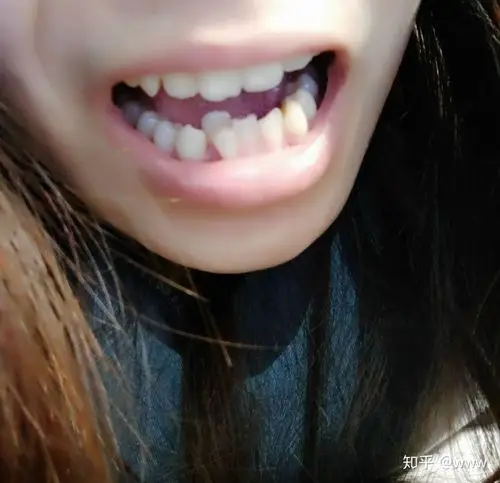 牙不齐是一种怎样的体验?