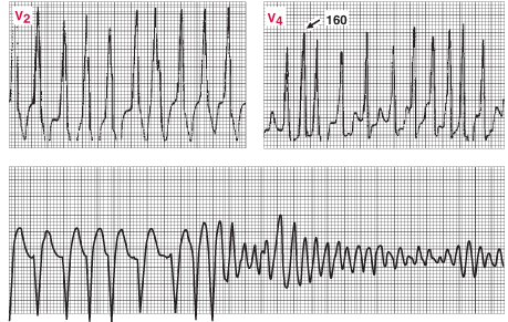 心房颤动和wpw综合征 (wpw)