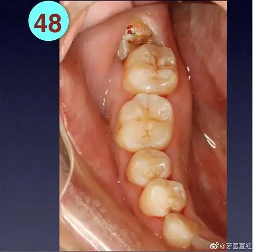 【位置不良的智齿为什么要在最好的时机尽早拔除?】 - 好大夫在线