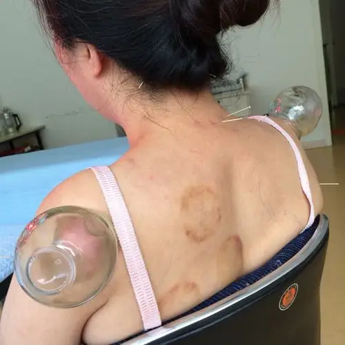 双侧肩周炎患者很少见,给予针刺,拔罐治疗一个月,现痊愈