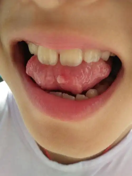 请问,舌头底下的这个小泡泡怎么回事啊?