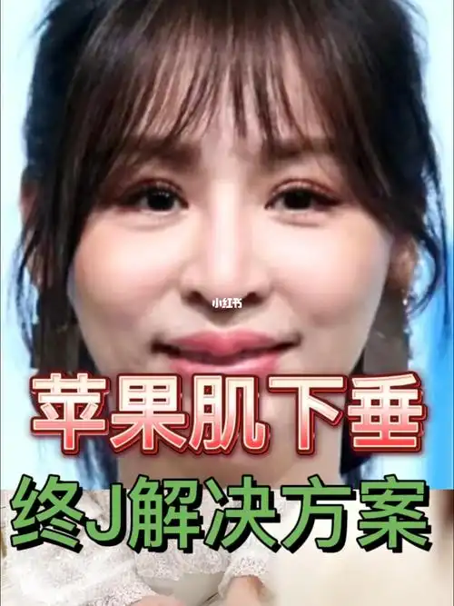 苹果肌下垂的终j解决办法