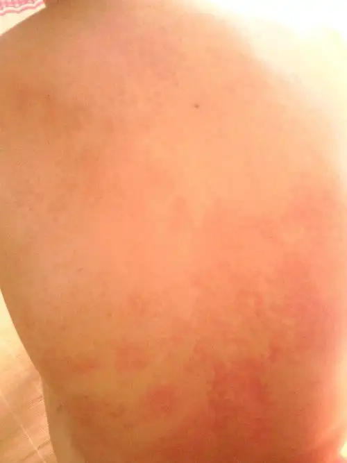 全身浑身都是发红的东西,主要上半身多,还不像疙瘩,皮肤非常痒,忍不住