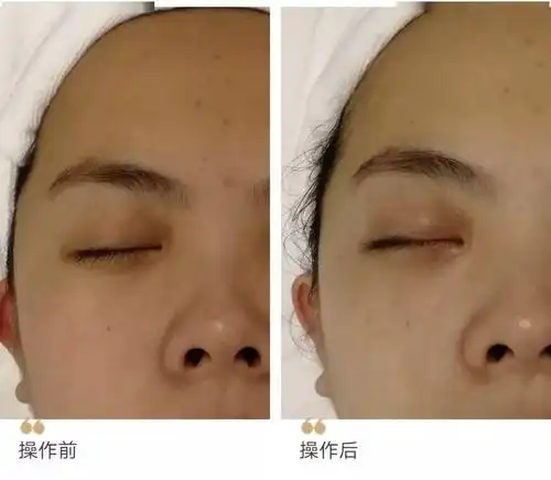 因为化妆品都有一些化学成分,会影响到术后恢复的效果;小气泡虽然是一