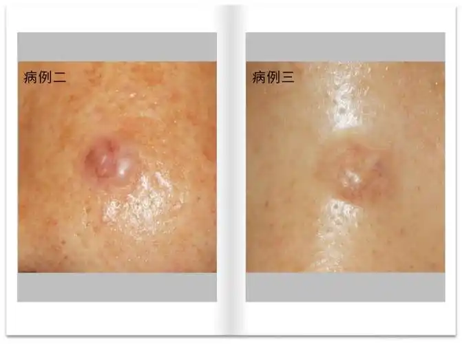 杨希川教授8个病例解读基底细胞癌bcc诊断与鉴别