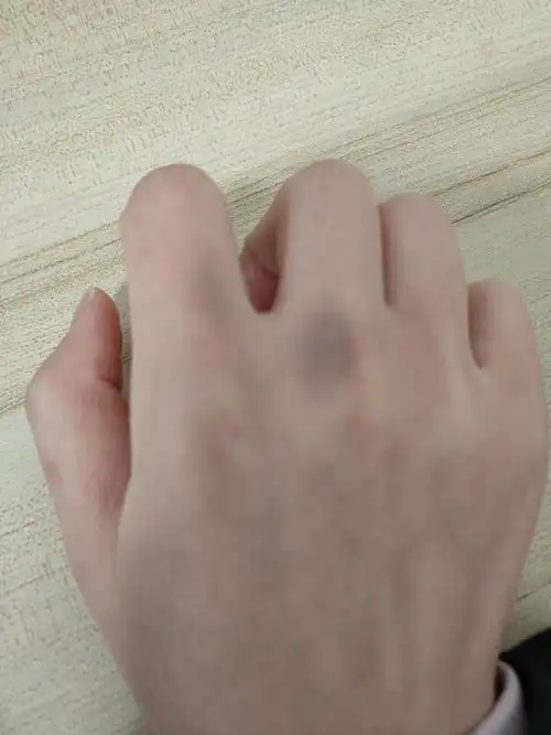 不知怎么回事,睡了一晚,第二天早上手上出现淤青.