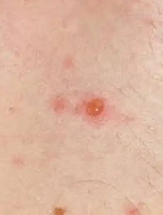 艾滋病的皮肤症状通常以黄斑,丘疹或疱疹为主要特征,2-3周后会自行