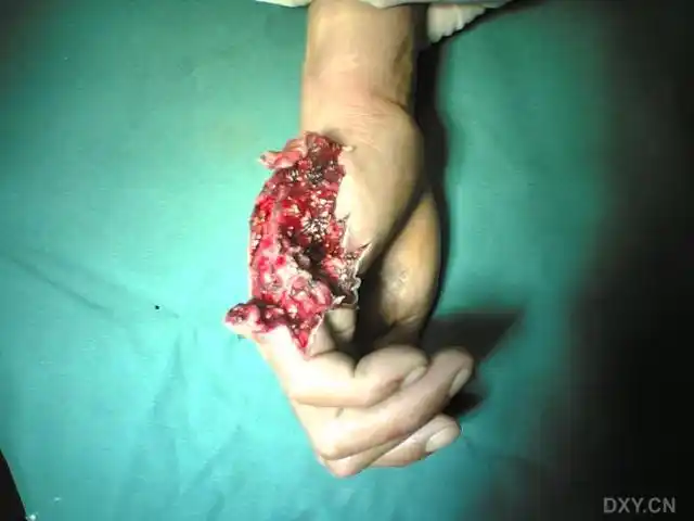 爆炸伤引起的小鱼际肌缺损