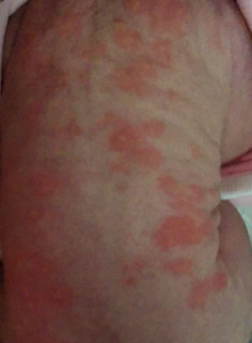 新生儿毒性红斑