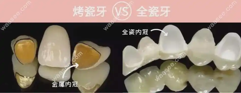 烤瓷牙和全瓷牙对比