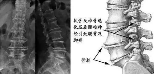 骨质增生原因有哪些_成都骨科医院-成都颈腰椎病医院-成都中山高新