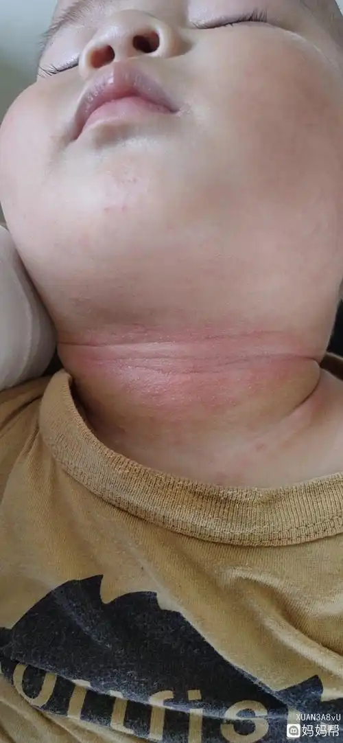 宝宝背后痱子怎么办(宝宝背后起痱子怎么处理)