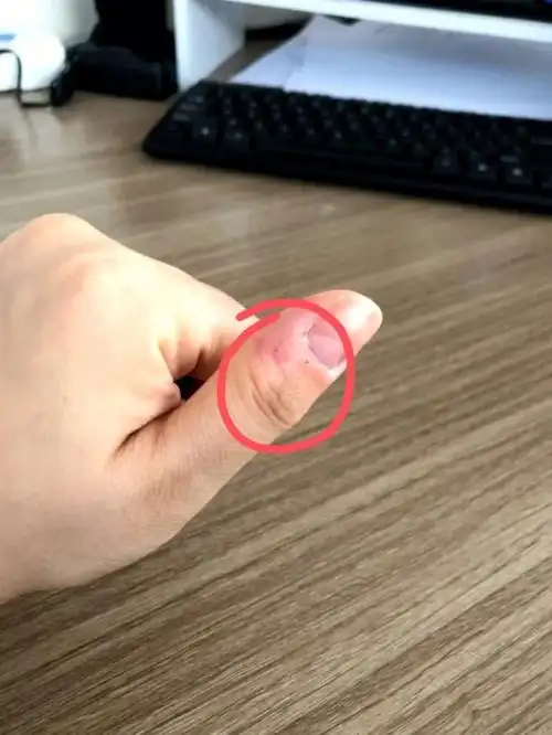 关节炎手指疼还有谁不知道这个管用贴剂的