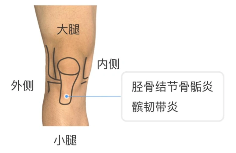 女孩每天跳绳3000个没长高却患上了胫骨结节骨骺炎