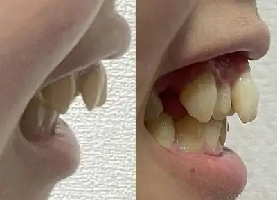 两分钟告诉你兔牙和龅牙的区别有哪些!-医秀网