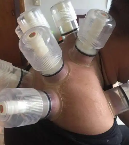 负压拔罐器治疗肩周炎