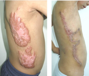 增生性瘢痕 - 瘢痕的分类与治疗 - 蔡景龙疤痕治疗【官方网站】