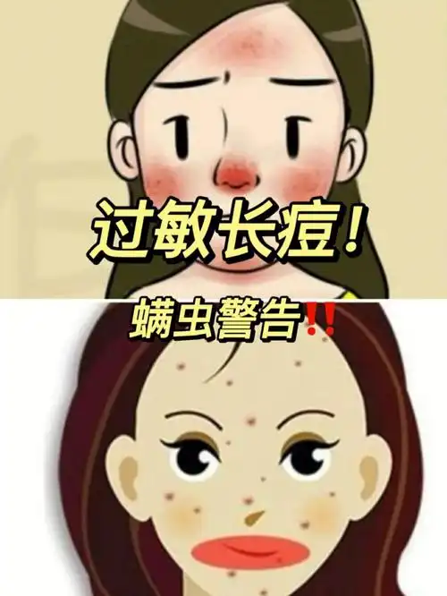 螨虫脸是怎么变牛奶肌的