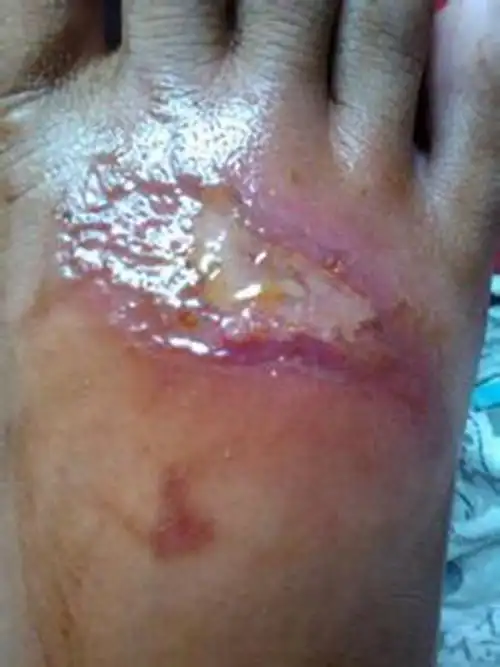 二级烫伤后恢复的图片_有来医生