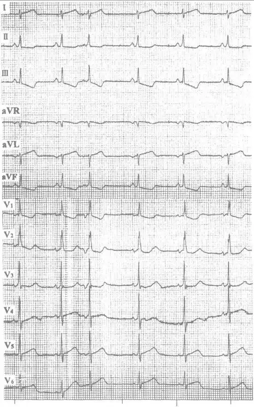 四,交界性早搏-12导联心电图同步诊断学-医学