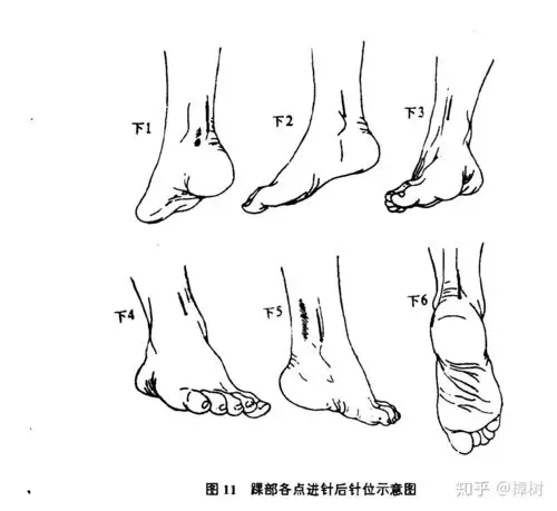 腕踝针针刺方法与病案杂谈