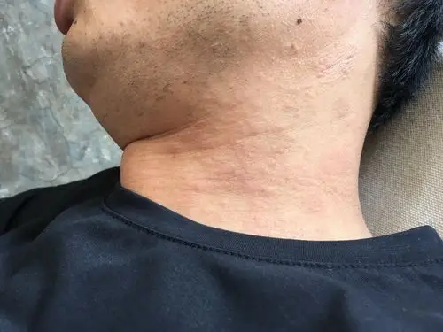 慢性肾功能不全3期,天天晚上睡着后感觉皮肤特别痒,.